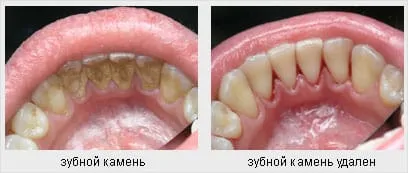 Как да се отървете от зъбен камък и плака най-добрите практики