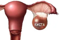 Cum pot trata chisturi ovariene boli metodamilechenie populare si maladii remedii populare -