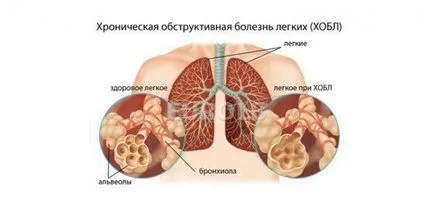 Hogyan kezeljük COPD kezelés gyógyszerek, népi sredtsvami krónikus obstruktív tüdőbetegség