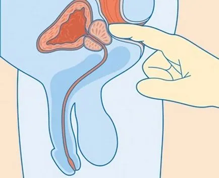 Как да се определи простатит с различни форми и да започне лечение