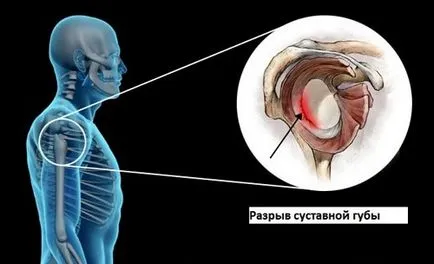 Как е магнитен резонанс на раменната става