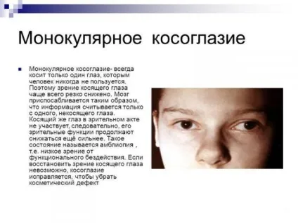 Монокулярний зір що це таке, лікування пов'язками диплопии, зорових аберації, відблисків (зір) Монокулярний зір що це таке, лікування пов'язками диплопии, зорових аберації, відблисків
