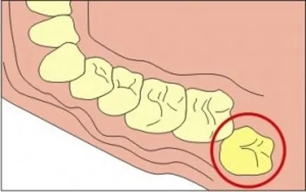 Care este înțelepciunea dinte - portal stomatologic