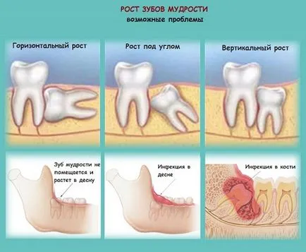 Care este înțelepciunea dinte - portal stomatologic