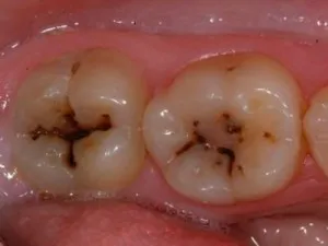 Hurutos glossitis - gyulladás a nyálkahártya a nyelv
