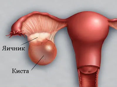 Кіста яєчника