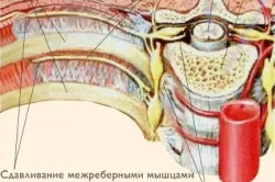 Колючий біль в області серця