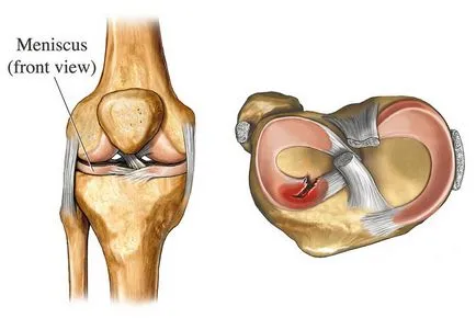 повреди снимките на колянната става менискусните