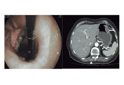 Tomografia computerizată a esofagului pentru diagnosticul tractului gastro-intestinal