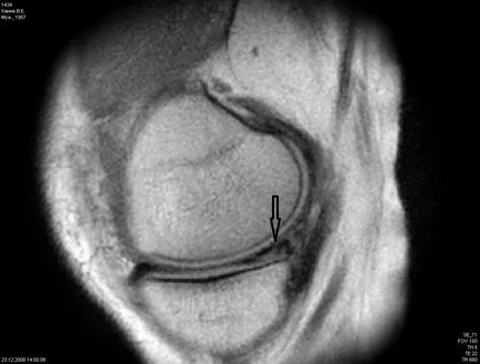 повреди снимките на колянната става менискусните