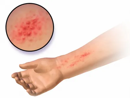 dermatită de contact pe unguente tratament mâini, remedii populare