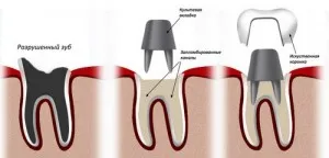 Протези върху зъба