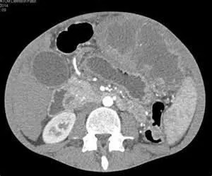 Rm de stomac și esofag, care arată o tomografie computerizată a stomacului și esofagului