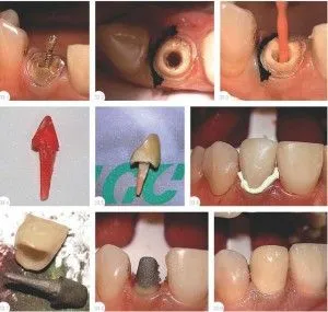 Coronamentele Crown sub instalare în stomatologie