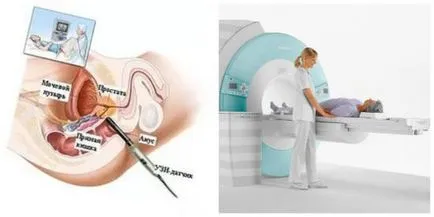 CT (tomografie computerizata) de prostata