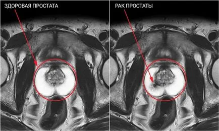 CT és MRI prosztatarák - a rák diagnózisa a tomográf