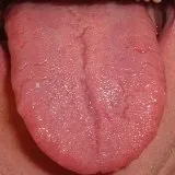 Наліт на мові діагностуємо захворювання - ваш доктор айболит (після) Наліт на мові діагностуємо захворювання - ваш доктор айболит