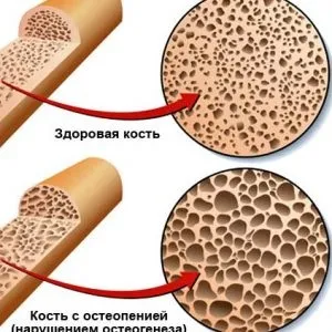 Чи можна вилікувати остеопению