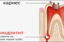 Лечение на болката след лечение на пародонтит