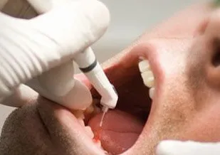 Laser implant dentar, beneficii și costuri, comentarii