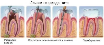 Изкачва мъдрец - симптоми, заобиколни решения съвети