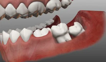 Urcă un dinte înțelepciune - simptome, workarounds, sfaturi