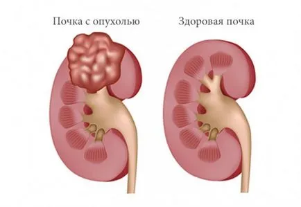 A vese kezelési tumor és gyógyító prognózisa