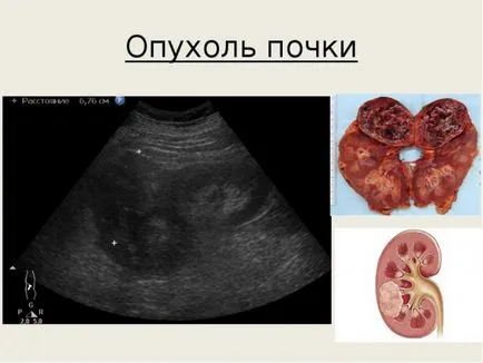 Лечение на бъбречно тумор и лечебни прогноза