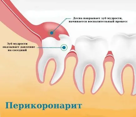 Изкачва мъдрец - симптоми, заобиколни решения съвети