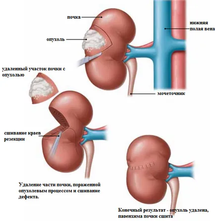 A vese kezelési tumor és gyógyító prognózisa