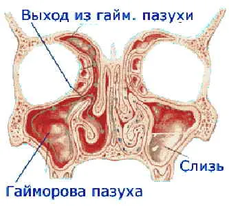 Вишневски маз по време на синусов национален начин срещу пробиване