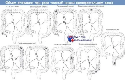 Техниката на резекция на дебелото черво на сигмоидна