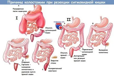 Техниката на резекция на дебелото черво на сигмоидна