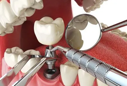 Material pentru un implant dentar - titan sau zirconiu