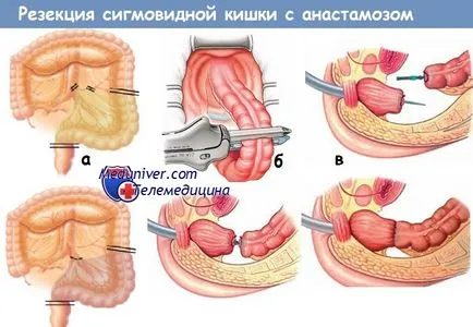 Техниката на резекция на дебелото черво на сигмоидна