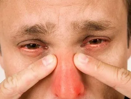Vishnevsky kenőcs - egy bevált orvosság arcüreggyulladás