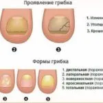 Mouse треска - симптоми при деца и възрастни, лечение и разбира се на болестта, съвети за