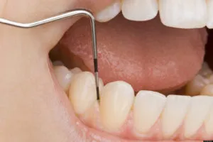 Arzén (orvosi) periodontitis és annak kezelése