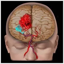MRI ангиография на кръвоносните съдове и артериите в мозъка, второ мнение