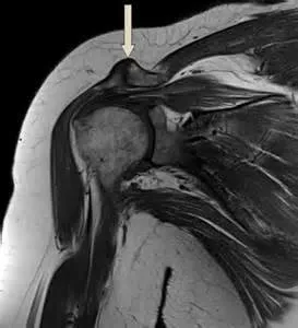 MRI a vállízület, amely kimutatható képalkotó váll, ár váll MRI