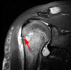 MRI a vállízület, amely kimutatható képalkotó váll, ár váll MRI