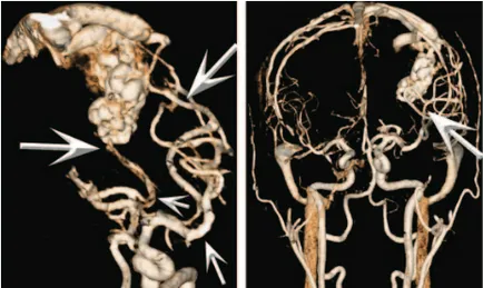 angiografia RMN a vaselor de sânge și a arterelor din creier, un al doilea aviz