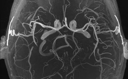 MRI angiográfia az erek és artériák az agyban, egy második véleményt
