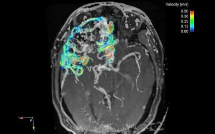 MRI ангиография на кръвоносните съдове и артериите в мозъка, второ мнение