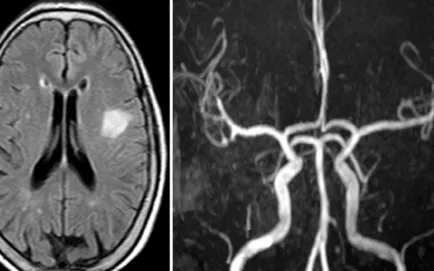 MRI angiográfia az erek és artériák az agyban, egy második véleményt