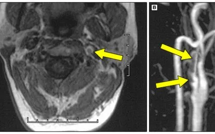 MRI ангиография на кръвоносните съдове и артериите в мозъка, второ мнение