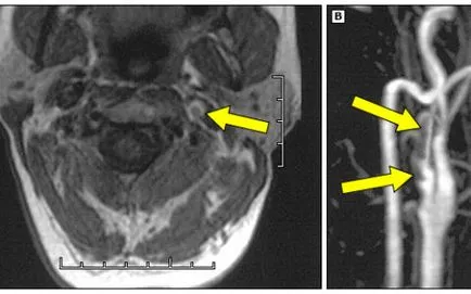 MRI angiográfia az erek és artériák az agyban, egy második véleményt