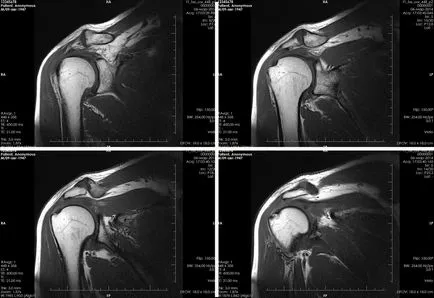 MRI a vállízület fotó, hogyan látja a videót, ár, vélemények