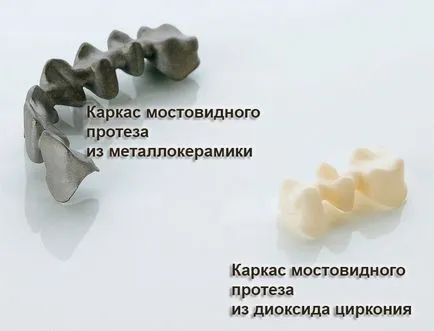 мостовідний протез