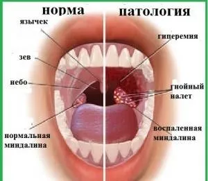 Настоянка евкаліпта інструкція із застосування засобу (лікування) Настоянка евкаліпта інструкція із застосування засобу